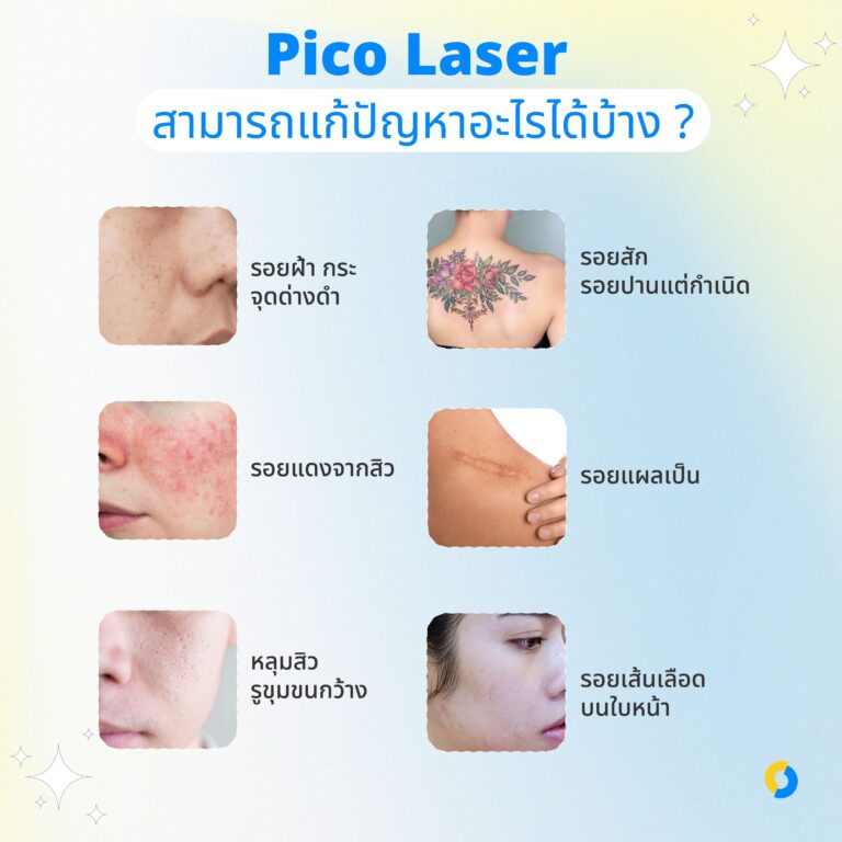 Pico Laser สามารถแก้ปัญหาอะไรได้บ้าง