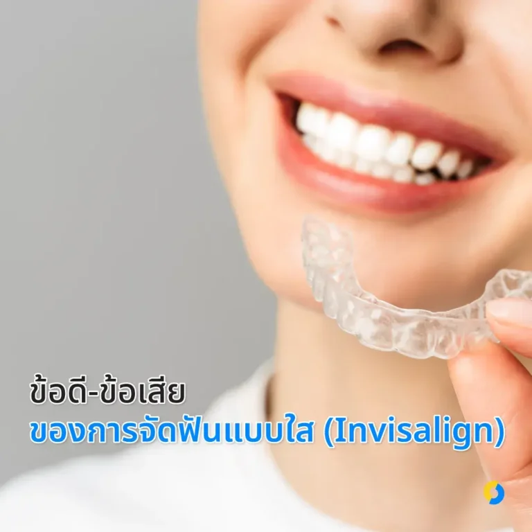 ข้อดี-ข้อเสียของการจัดฟันแบบใส (Invisalign)