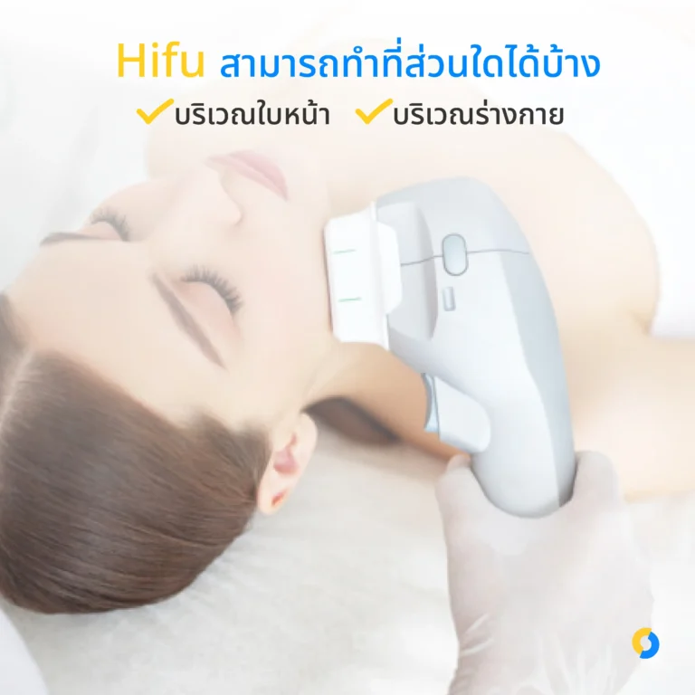 Hifu สามารถทำที่ส่วนใดได้บ้าง